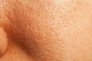 Hidrolat de lavanda pentru ten poros