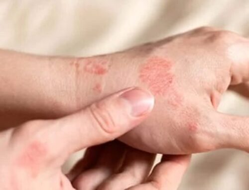 Dermatita alergică: Metode simple de ameliorare cu uleiuri esențiale